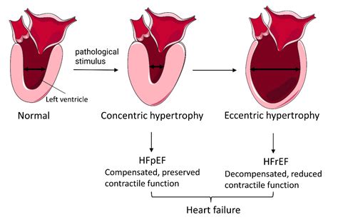 eccentric vs concentric hypertrophy heart